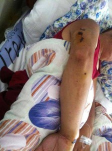 Bullet wounds on Tsewang Choephel's upper arm.